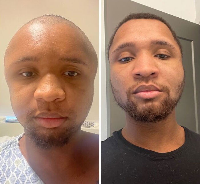 "2 miesiące temu przeszedłem operację rekonstrukcji twarzy. Teraz czuję się zdecydowanie pewniej."