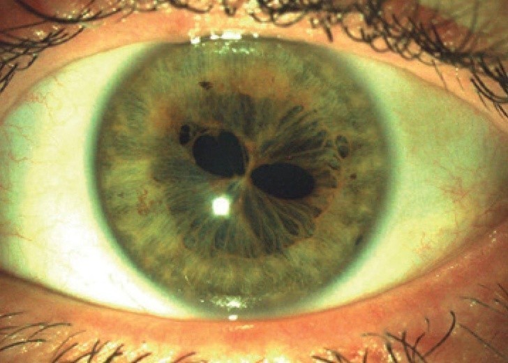 5. Ludzkie oko z polikorią (rozdwojeniem źrenicy)
