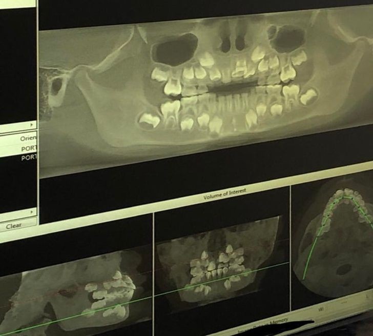 1. Dentystyczne zdjęcie rentgenowskie pokazujące niewyrośnięte zęby u dziecka
