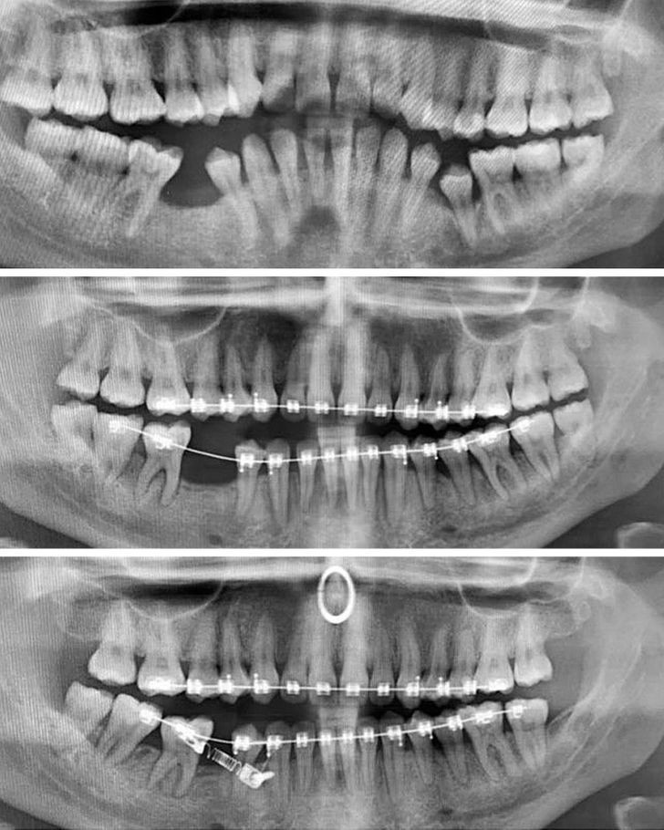14. „Zdjęcie rentgenowskie moich zębów przed założeniem aparatu ortodontycznego i dwa lata później.”