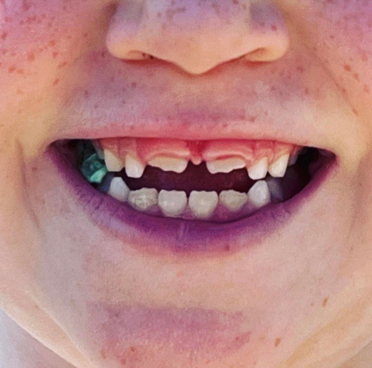 "Mojemu 6-latkowi wyrastają zęby. Przerwa między nimi wygląda jak symbol Batmana."