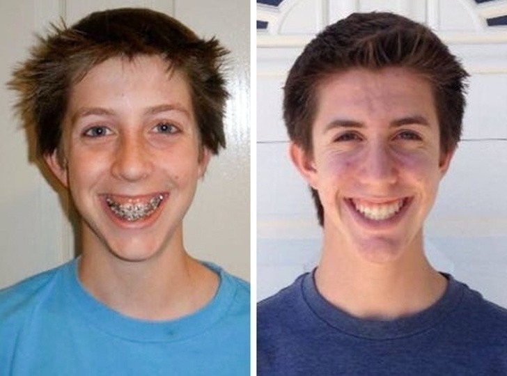 Przed i po noszeniu aparatu. 4 lata to dużo czasu...