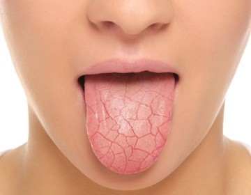 4. Suchość w ustach