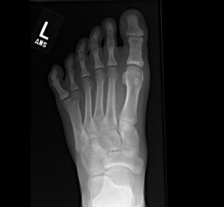 Szósty palec u stopy widoczny na zdjęciu rentgenowskim