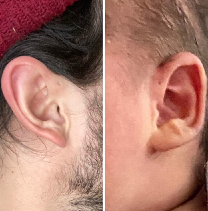 "Ja i mój syn posiadamy znamiona na uchu, dokładnie w tym samym miejscu."
