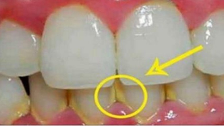 Przeczytaj jak pozbyć się kamienia z zębów w 5 minut naturalnymi składnikami! Bez wizyty u dentysty!