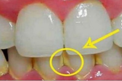 Przeczytaj jak pozbyć się kamienia z zębów w 5 minut naturalnymi składnikami! Bez wizyty u dentysty!