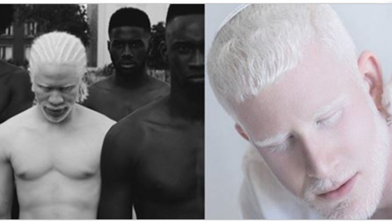 17 zdjęć ludzi cierpiących na albinizm! Wyglądają jak duchy, aż ciężko uwierzyć, że to nie przeróbki!