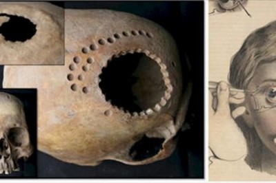 9 przerażających zabiegów lekarskich z przeszłości które dziś szokują! Pomysł na lewatywę szokuje! 