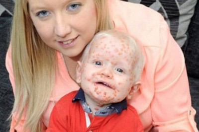 Była przekonana, że jej dziecko ma ospę i szybko wyzdrowieje! Wtedy usłyszała wstrząsającą diagnozę! 