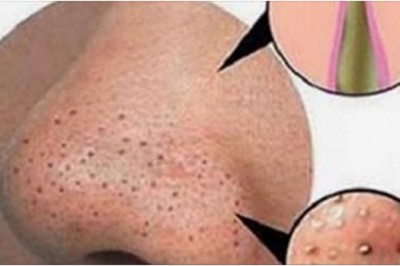 Chcesz skutecznie pozbyć się zaskórników?! Ten genialny sposób sprawdzi się u każdego! 