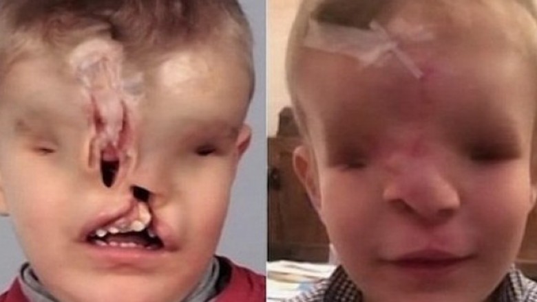 Dziecko bez oczu i nosa odzyskało twarz. Cud medycyny.