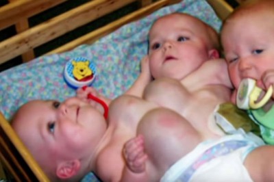 Gdy się urodziły połączone, lekarze nie dawali im szans na przeżycie! Nie uwierzysz jak dziś wyglądają!