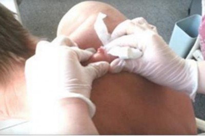 Gdy zaczął wyciskać tego pryszcza zrobiło mi się niedobrze! Nie dasz rady obejrzeć do końca!