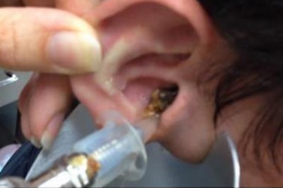 Lekarz był w zszokowany widząc co wypływa! Takiego efektu płukania ucha nie mógł przewidzieć!