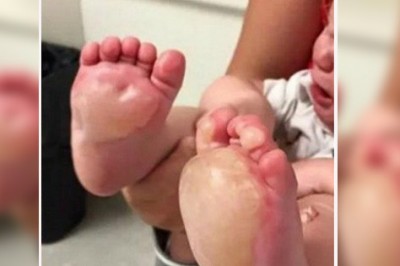 Mama widzi pęcherze na stopach córeczki! Gdy zrozumiała co zrobiła opiekunka wpadła w furię! 