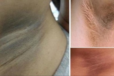 Masz problem z ciemnymi pachami? Zobacz domowy 3 minutowy zabieg który pozbyć się tego problemu!