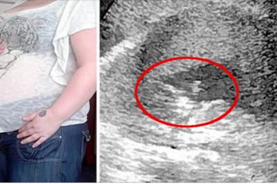 Na USG lekarz widzi malutką rączkę! Po chwili jest w szoku gdy odkrywa co jeszcze jest w jej brzuchu! 