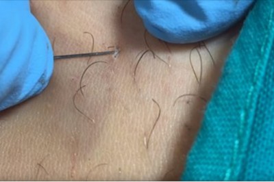 Nienawidzi tego każda kobieta! Zobacz profesjonalne usuwanie wrośniętych włosków w okolicach bikini!