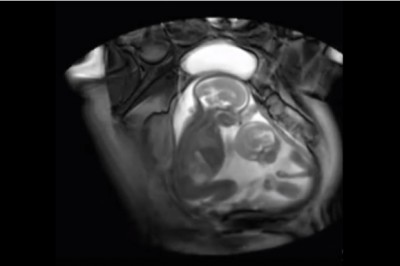 Niesamowite zdjęcia bliźniaków w łonie matki walczących o miejsce! Cudowne! 