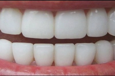 Niesamowity 3 minutowy sposób jak uzyskać naturalnie białe zęby w domu! 