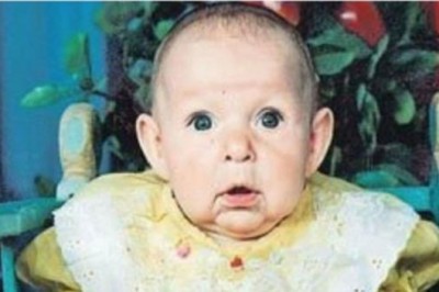 Ojciec wyrzekł się swojej córki widząc jej twarz gdy dorasta! Po 20 latach udowodniła gdzie tkwi piękno!