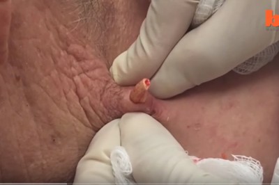 Pani doktor, mam tu takiego pryszcza... Najbardziej obrzydliwe przypadki problemów z cerą!