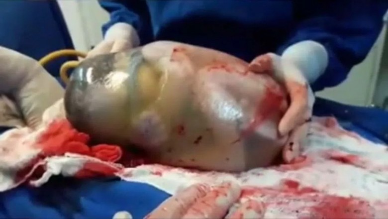 Pielęgniarka uchwyciła niesamowity poród! Dziecko rodzi się w nienaruszonym worku owodniowym