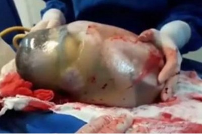 Pielęgniarka uchwyciła niesamowity poród! Dziecko rodzi się w nienaruszonym worku owodniowym