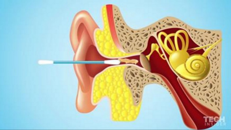 Po obejrzeniu tego nigdy już nie użyjesz patyczków do czyszczenia uszu! Nie wiedziałam, że mogą być niebezpieczne! 