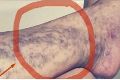 Potrafią zrujnować wygląd najpiękniejszych nóg! Poznaj domowe naturalne metody na żylaki nóg!