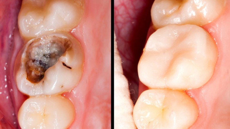 Pozbądź się próchnicy i zapobiegaj dziurom w zębach w 5 prostych krokach! Naturalna metoda! 