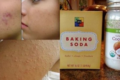 Pozbądź się trądziku i wągrów dzięki tej paście domowej roboty! Zobacz jak idealnie oczyszcza pory!