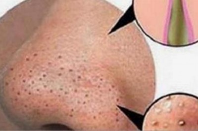 Próbujesz skutecznie pozbyć się zaskórników?! Ten domowy naturalny sposób sprawdzi się u każdego!