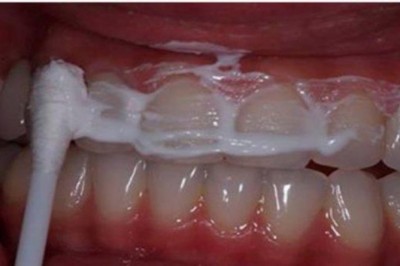 Ta prosta metoda pozwoli uzyskać śnieżnobiałe zęby i rozjaśni Twój uśmiech! Do tego jest bardzo tania! 