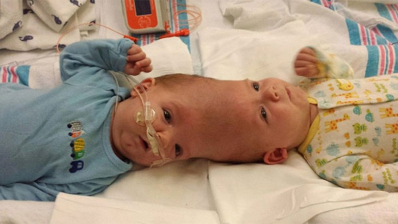 Te bliźniaki syjamskie urodziły się zrośnięte głowami! To jak wyglądają po 27 godzinnej operacji to cud! 
