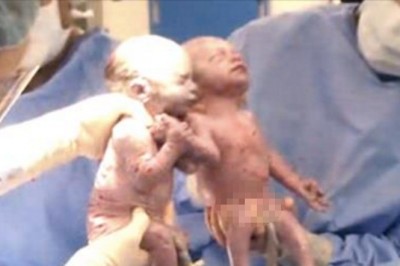 Urodziły się trzymając za ręce! Dwa lata później są sobie bliższe niż ktokolwiek się spodziewał! 