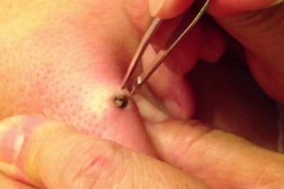 W końcu się odważyła wycisnąć 20 letniego wągra! Nie uwierzysz ile tego było! 