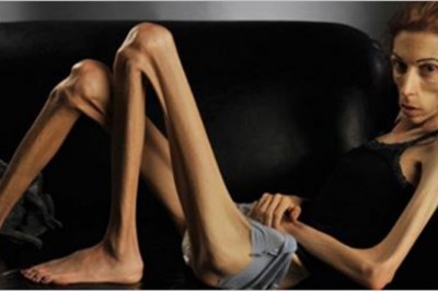 Ważyła zaledwie 20 kg i była na skraju śmierci! Dzięki pomocy ludzi zmieniła się nie do poznania!