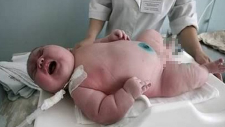 Ważąca 270 kg kobieta zaszokowała lekarzy! Rodzi największe dziecko świata ważące aż 18 kg! 