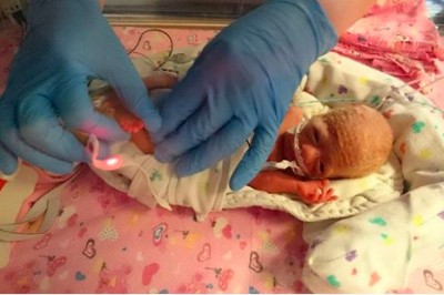 Wcześniak umierał lekarzowi na rękach! Podjął więc kontrowersyjną decyzję, by ratować jej życie! 