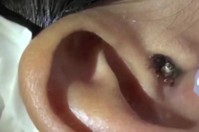 Zakropiła kilka kropel wody na jego ucho! To co wyszło ze środka jest po prostu przerażające!