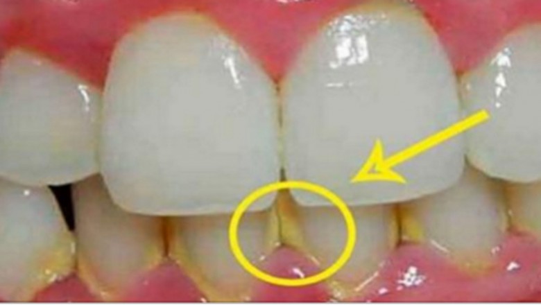 Zobacz jak usunąć kamień z zębów w 5 minut naturalnymi składnikami! Bez wizyty u dentysty! 