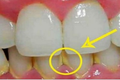 Zobacz jak usunąć kamień z zębów w 5 minut naturalnymi składnikami! Bez wizyty u dentysty! 