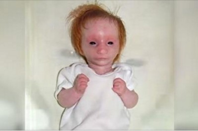 Kiedy się urodziła wyglądała jak porcelanowa lalka! Po 5 latach lekarze są zaskoczeni jak się zmienia!