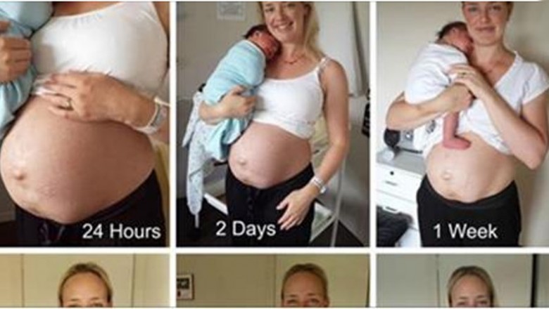 Odważna mama pokazuje zdjęcia brzucha dzień po urodzeniu! 14 tygodni później zupełnie się zmienia!