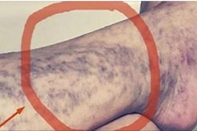 Każdy ma w domu lekarstwo na żylaki, ale wiele osób o tym nie wie! Naturalny i skuteczny!