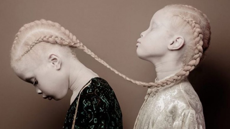 Bliźniaczki cierpiące na albinizm pozują do niezwykłej sesji! Ale to wygląd 3 siostry budzi emocje!