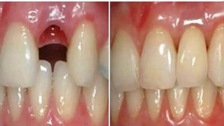 Dentyści znaleźli sposób na wyhodowanie nowego zęba w 9 tygodni! Dzięki komórkom macierzystym! 