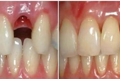 Dentyści znaleźli sposób na wyhodowanie nowego zęba w 9 tygodni! Dzięki komórkom macierzystym!